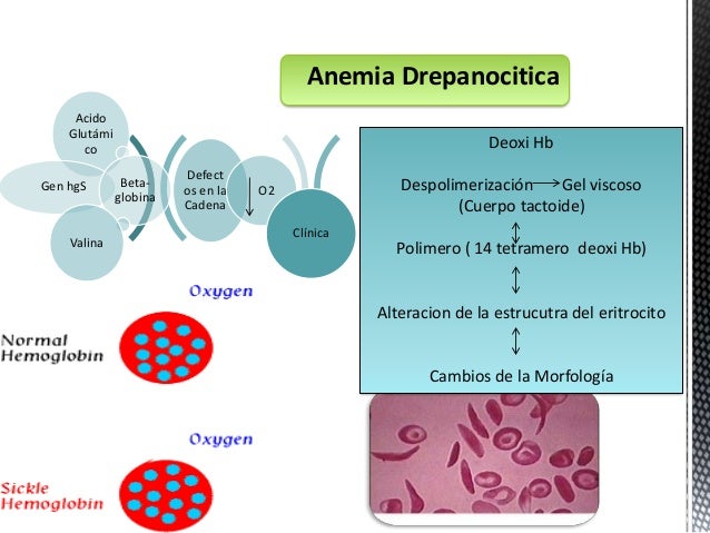 anemia drepanocitica pediatria